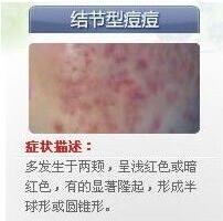 青春痘,痘痘等级分类及图片