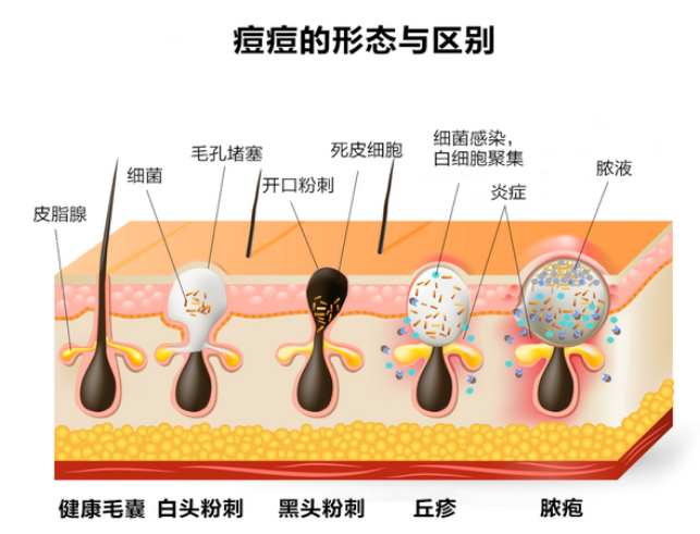 粉刺类型有哪些图片说明