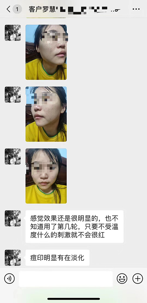 怎么去痘印 去痘印最有效的产品