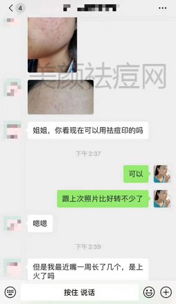 囊肿型痘痘怎么消除