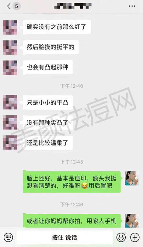 脓包型痘痘用什么药膏 怎么处理