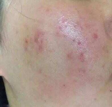 红色痘印会留一辈子吗