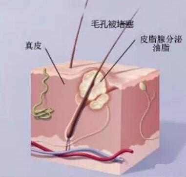 脸上老起痘什么原因导致的