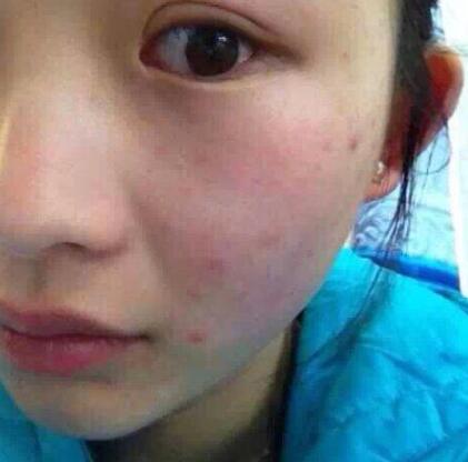 怎么祛痘有效果最快方法