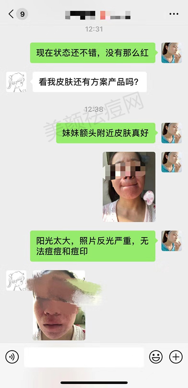 囊肿型痘痘怎么治