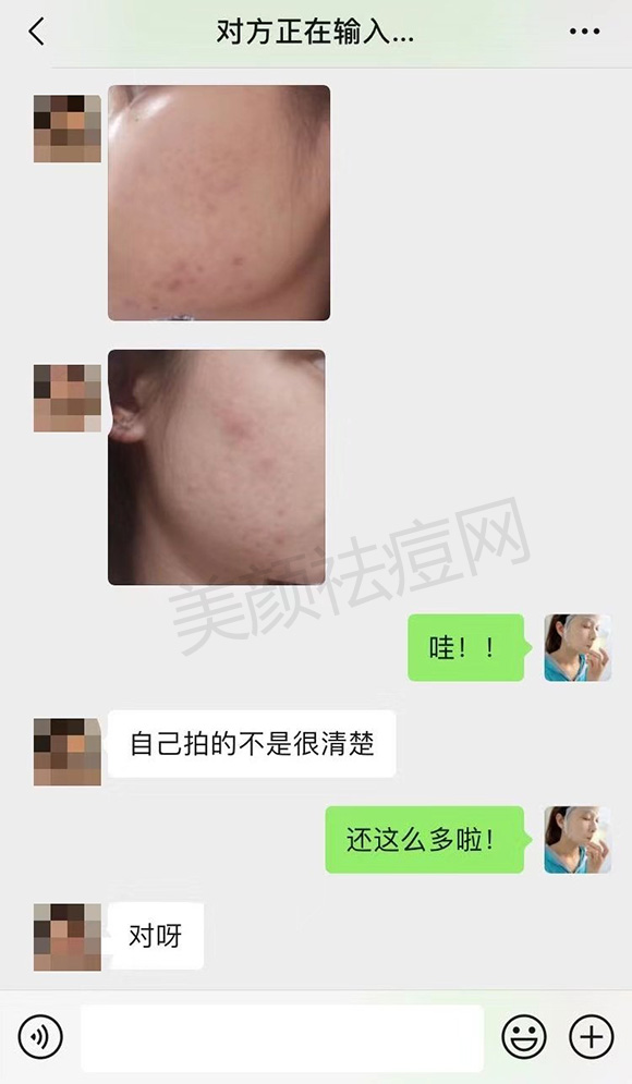 囊肿型痘痘怎么除根